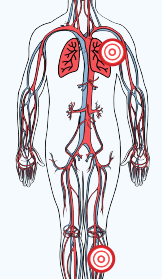 Color drawing of the cardiovascular system, neck down. There is a red bullseye on the left lung, and on the left leg.